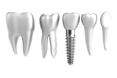 Dental Implants